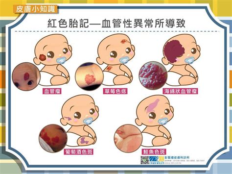 右邊是哪邊 嬰兒胎記